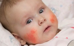 Are babies allergic to buckwheat