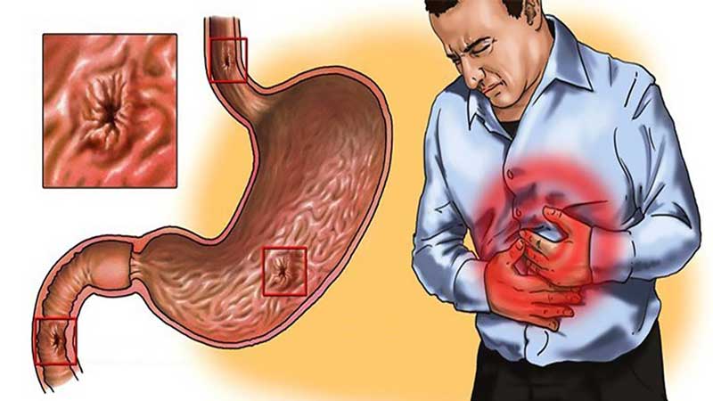 Is it possible to eat beets for gastritis: we get acquainted with the contraindications and cook according to the best recipes for a weak stomach