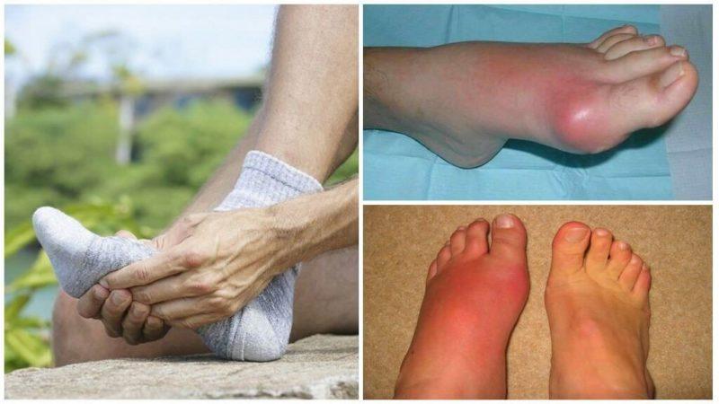 Is it possible to eat beets for gout: we will analyze the arguments for and against