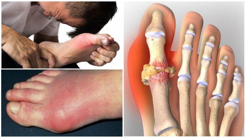 Eating corn for gout: is it possible or not, how to eat it so as not to harm your health
