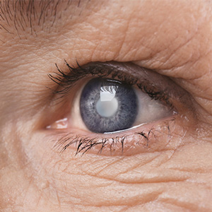 Prevention and treatment of cataracts with dill: recipes, instructions for use and reviews