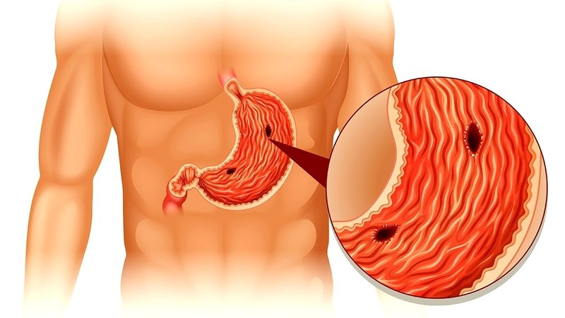 Is it possible to melon with a stomach ulcer: arguments for and against, contraindications