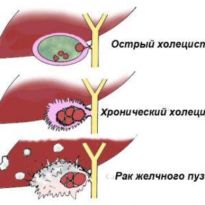 Is it possible to eat watermelon with cholecystitis and pancreatitis