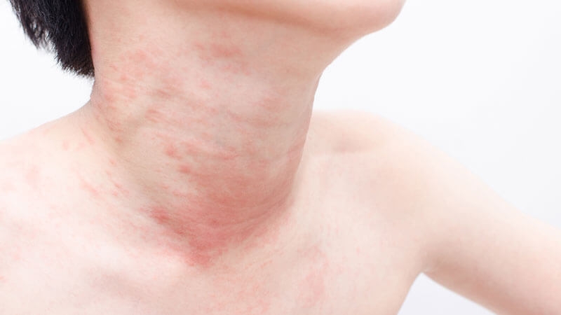 Is rice allergy possible and how does it manifest?