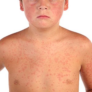 Is rice allergy possible and how does it manifest?