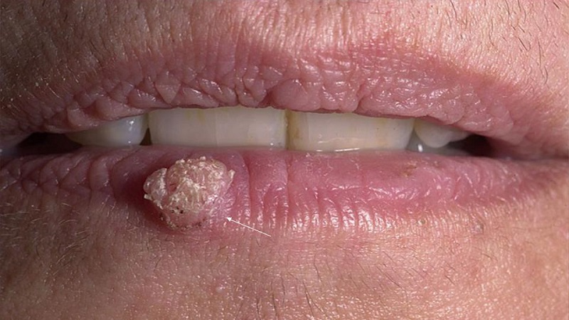 How to get rid of warts with potatoes