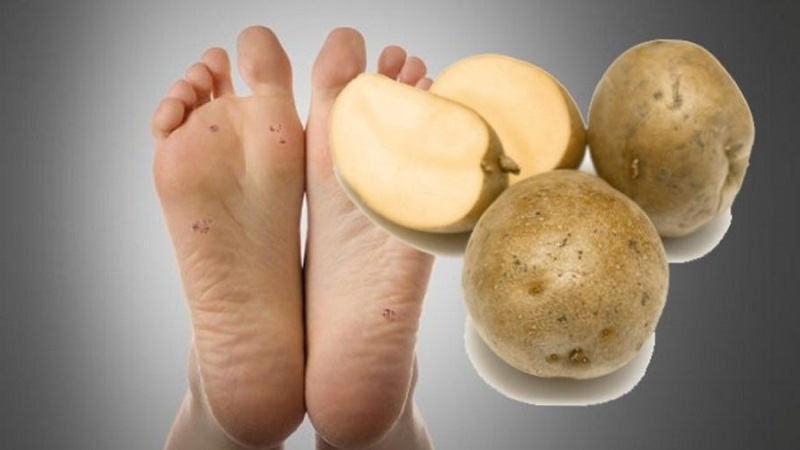 How to get rid of warts with potatoes