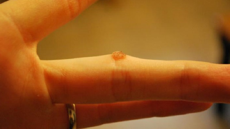 How to get rid of warts with potatoes