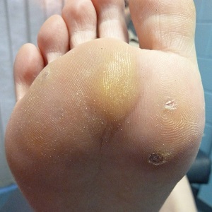 How to get rid of warts with potatoes