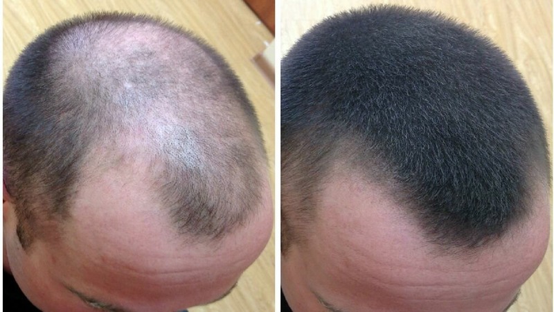 Onion hair masks for hair loss treatment
