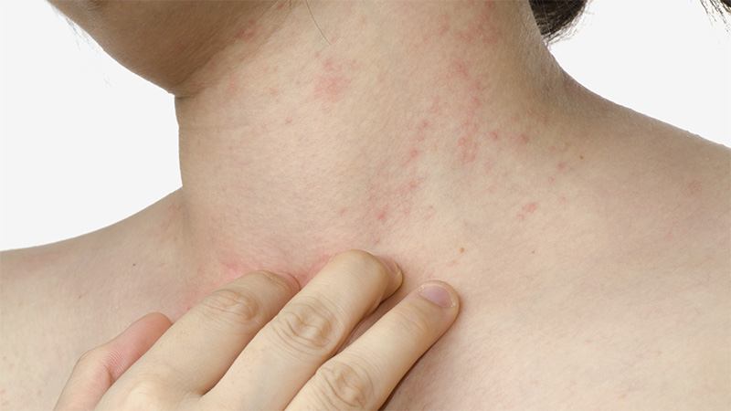 Can there be an allergy to carrots, how it manifests itself and how is it treated?