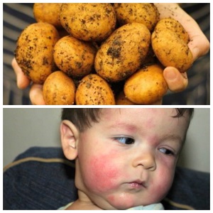 How is potato allergy manifested in children and adults