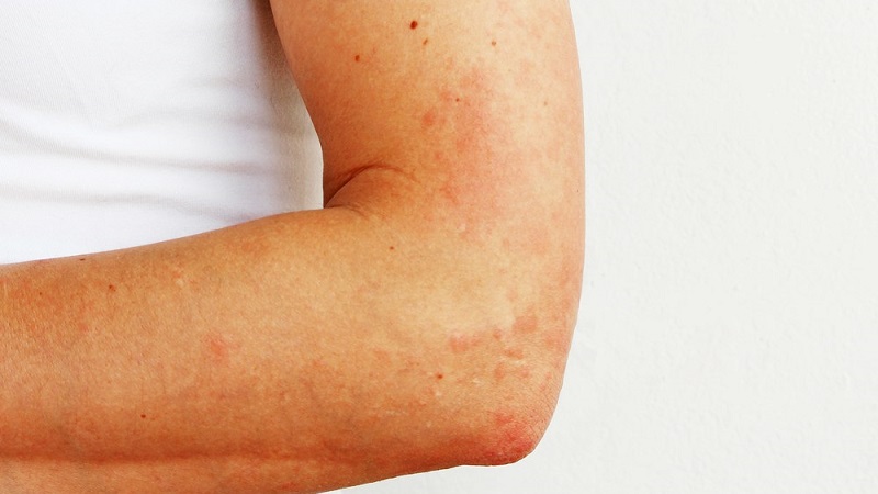 How is potato allergy manifested in children and adults