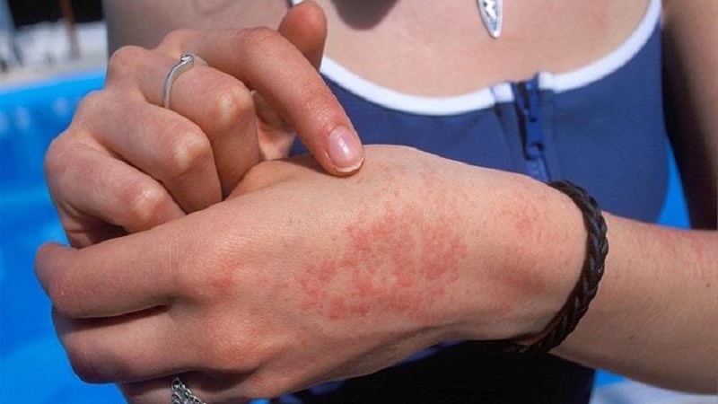 How is potato allergy manifested in children and adults