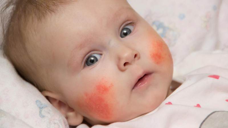 Are babies allergic to buckwheat