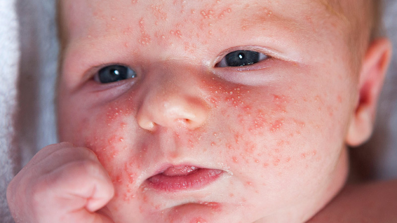 Are babies allergic to buckwheat