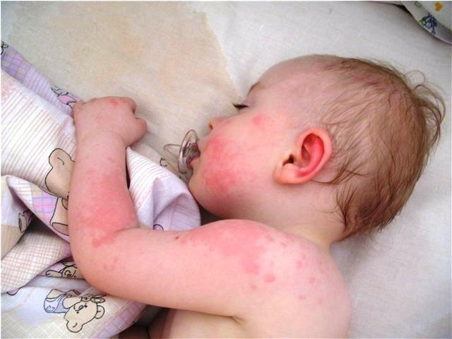 Is there an allergy to cauliflower in babies?
