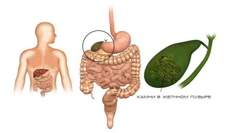 Watermelon with stones in the gallbladder: is it possible to eat and in what quantities